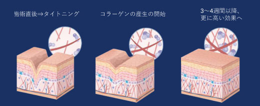 効果の実感まで